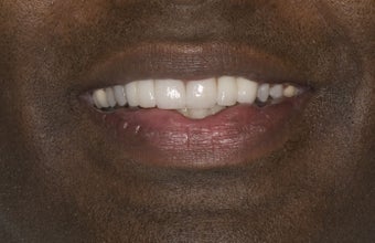 Porcelain Crowns after 374775