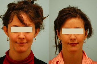 Otoplasty (Cosmetic Ear Pinning) before 136386