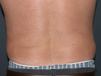 Body Liposculture after 486600