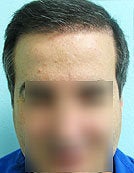 FUE – BHT by SFET Using Only Nape, Head and Body Hair after 196036