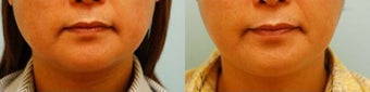 Botox Jaw Reduction before 136832