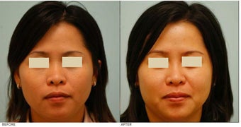 Dallas Asian Rhinoplasty before 136821
