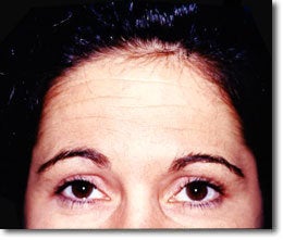 Botox before 565995