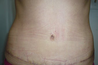 Smartlipo / liposuction after 166271