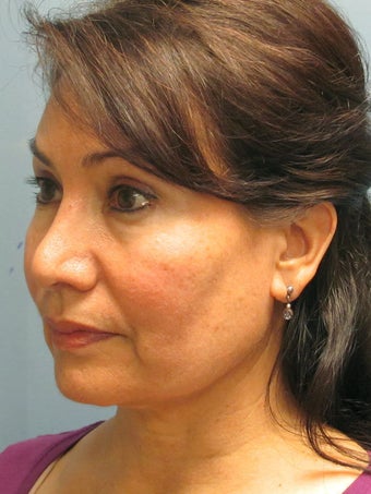 Chin Augmentation 635124
