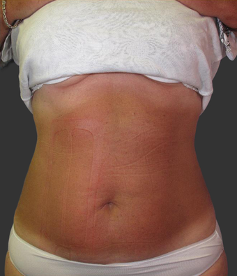 Exilis after 423765