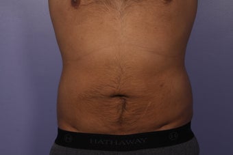 Liposuction after 526783