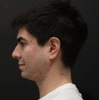 Laser Assisted Lipocontouring of the neck 540401