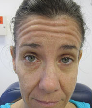 Botox before 387834