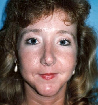 Rhinoplasty after 355873