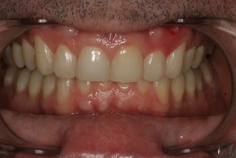 Invisalign Treatment after 92848