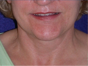 Necklift after 208457