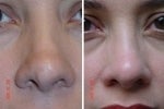 Non Surgical Rhinoplasty before 588457