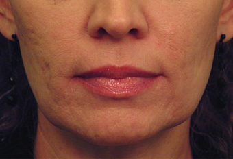 Yag Laser Skin Tightening before 622085
