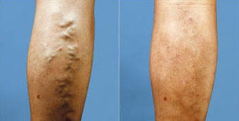 Veins before 242540