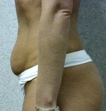 Mini abdominoplasty before 249534