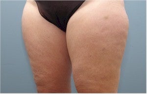 Smartlipo before 607207