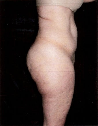 Liposuction before 500014