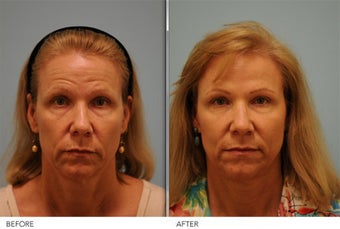 Short Term Botox before 345398