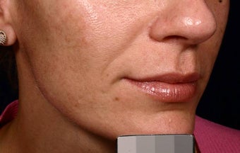 Restylane before 137840