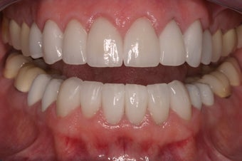 replacement of old restorations and new smile design after 330060