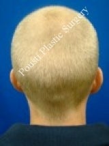 Ear Surgery (Otoplasty) before 616669
