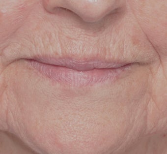 Laser Resurfacing before 588404