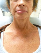 Poikiloderma Treatment with Vbeam after 196050