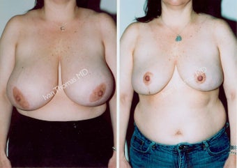 Breast Reduction before 243744