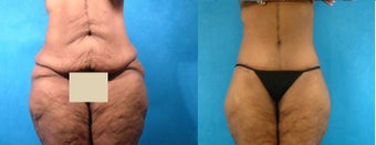 Lower Body Lift before 101238