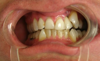 Smile Makeover before 466394