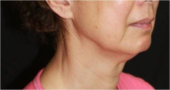 Ultherapy 421635