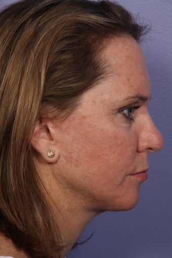 Neck Lift after 306409