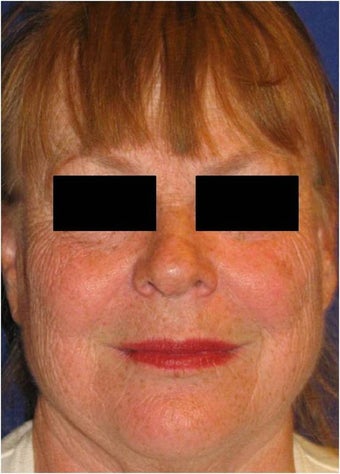 CO2 Laser Resurfacing ~ Active & Deep FX before 130742