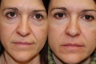 Non-Surgical Facial Rejuvenation with Silikon-1000 before 154690