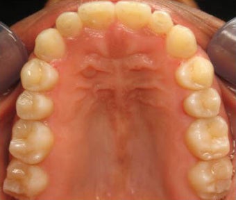 Invisalign after 436971