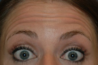Botox injected in between the eyebrows and into the forehead 577107