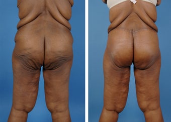 Lower Body Lift with Laser Liposuction to the Hips and Thighs 335995