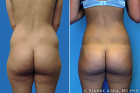 Brazilian Butt Lift before 216764