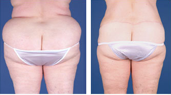 Central body lift with liposuction age 53 after 6817