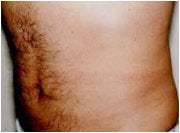 Liposuction after 205393