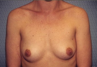 Breast Augmentation before 266792