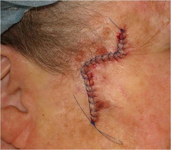 Closure of Mohs Surgery Defect after 82499