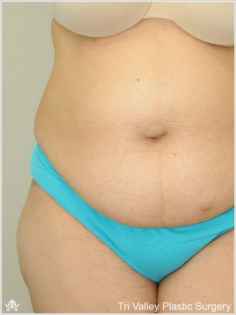 Liposuction before 420931