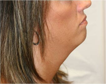 SmartLipo of Neck - Right Lateral View before 109277