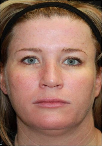 Ultherapy before 445623