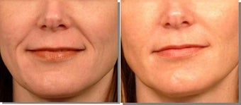 Radiesse to smile lines before 6599