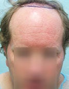 Repair by FUE – SFET Using Head, Nape and Beard Hair to create Hairline before 196039