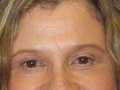 Brow Lift after 541473
