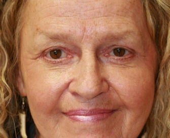 Upper Eyelid Blepharoplasty and Corner of Lip Lift after 326447